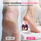 42% Urea and 2% Salicylic Acid Exfoliating Body Bar